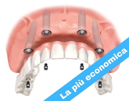 BASIC<br>Full-arch
