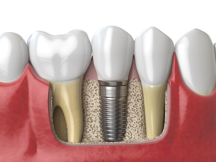 Preservazione alveolare e piccole ricostruzioni